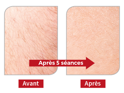 Lumière Pulsée - Avant - Après... Lumière Pulsée - Avant - Après...